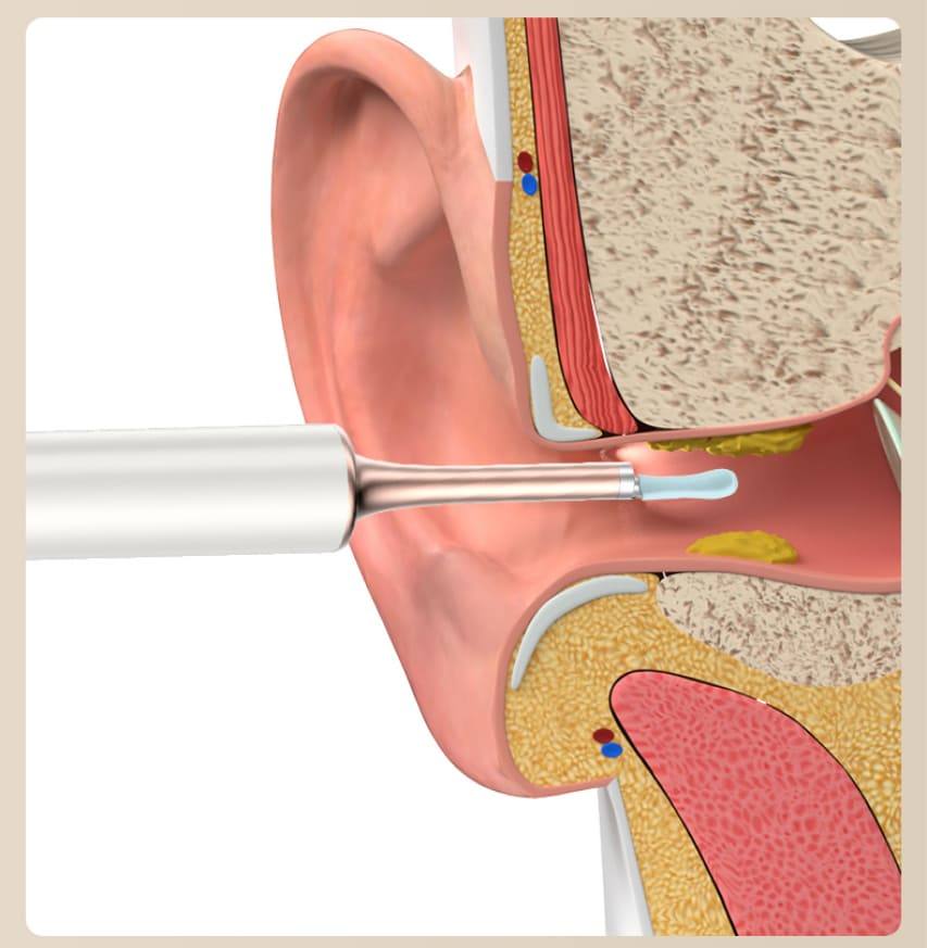 dissolvant de cérumen nettoyant l'oreille